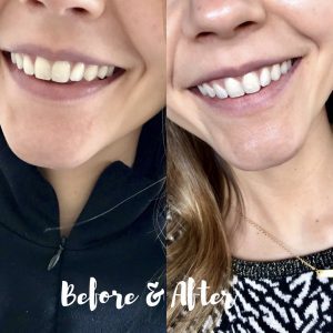 Lumineux Teeth Whitening Strips