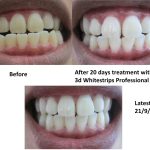 Crest Professional Effects Whitestrips